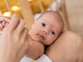 bebê com indício de sarna na testa