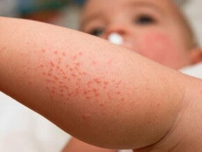 Close-up do braço de um bebê com pequenas manchas vermelhas elevadas, mostrando a aparência típica da brotoeja em bebê ou miliária, uma irritação comum da pele.