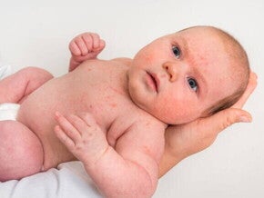 Um bebê com diversas manchinhas vermelhas espalhadas pelo corpo, sendo segurado nos braços de uma pessoa.