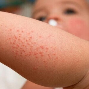 Close-up do braço de um bebê com pequenas manchas vermelhas elevadas, mostrando a aparência típica da brotoeja em bebê ou miliária, uma irritação comum da pele.