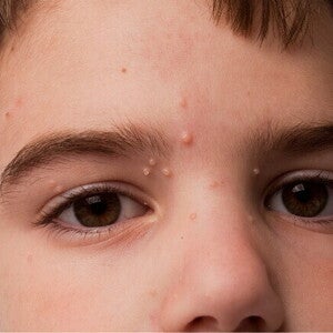 Close-up do rosto de uma criança, com múltiplas pequenas protuberâncias de cor clara, possivelmente lesões de molusco contagioso, visíveis na testa e nas pálpebras. Close-up do rosto de uma criança, com múltiplas pequenas protuberâncias de cor clara, possivelmente lesões de molusco contagioso, visíveis na testa e nas pálpebras.